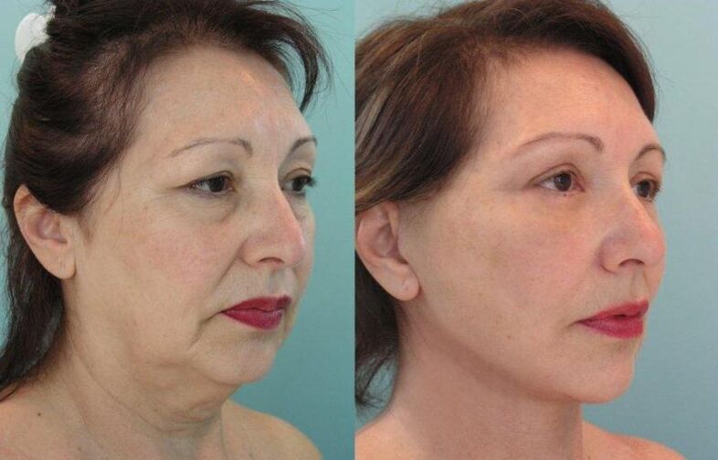 The rejuvenating effect of facial skin tightening with threads