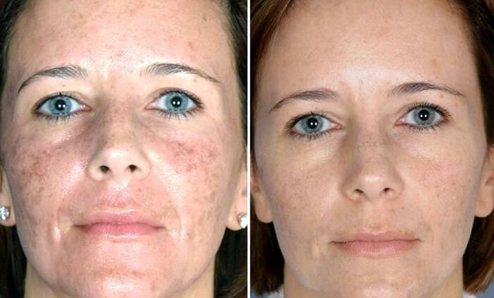 photo before and after fractional laser renewal
