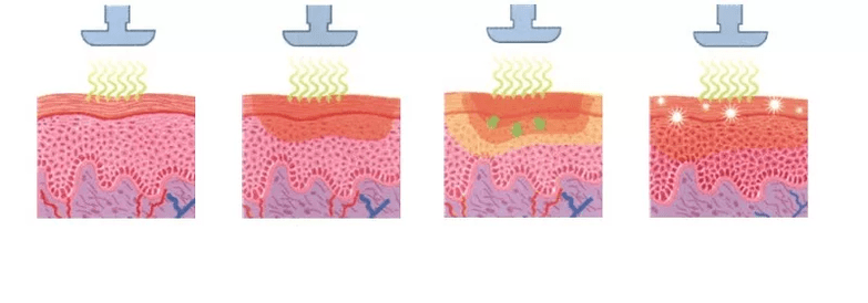 How a skin rejuvenation device works